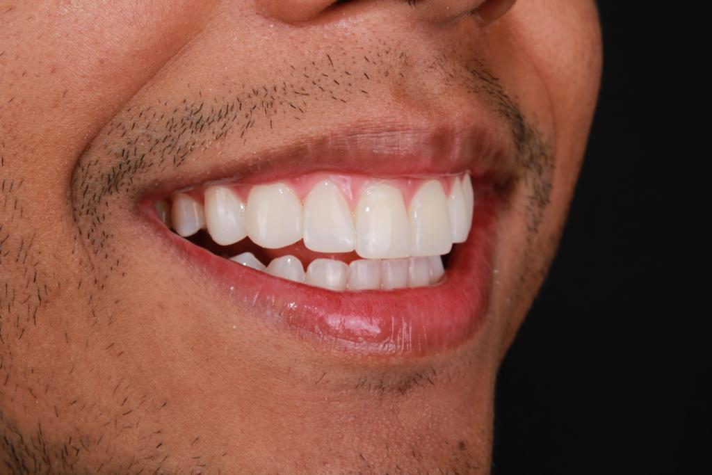 Microdiseño de sonrisa